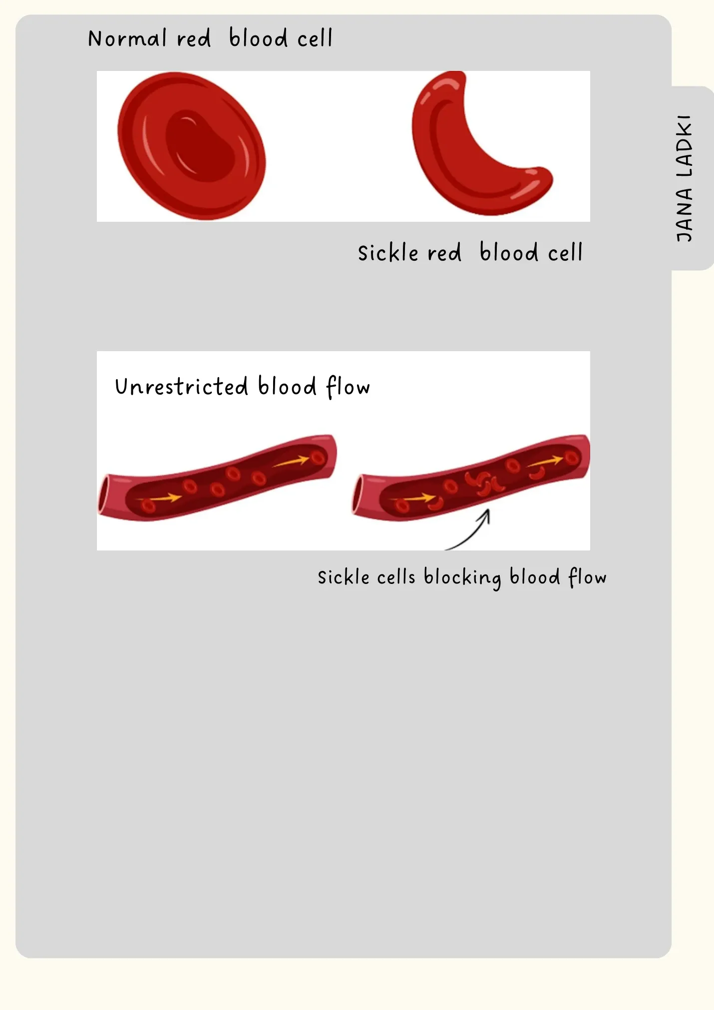 Diagrams of a normal versus sickle red blood cell, and of normal blood flow versus sickle cells blocking a vessel.