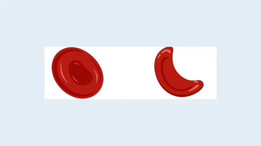 Illustration comparing a normal round red blood cell with a sickle-shaped one.